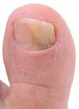 Photos of Big Toenail Infection Home Remedies