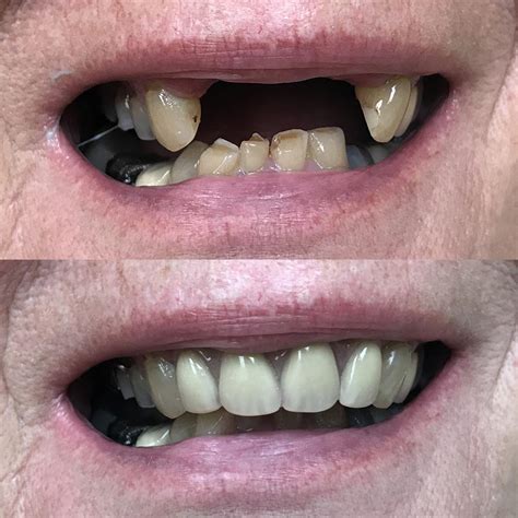 Partial Denture Upper Front Teeth