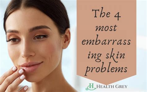 4 embarrassing different types of skin problems on face health grey