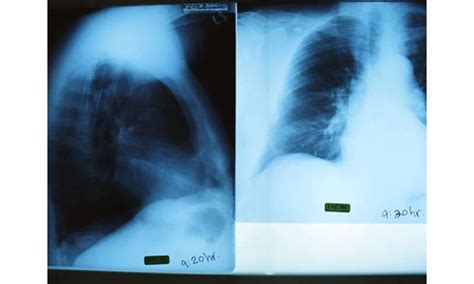 Chest X Ray Findings Normal For Many Confirmed Covid 19 Cases Health