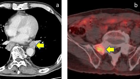 Pet Ct Showed New Metastasis In Hilar Lymph Node And Sacrum Download