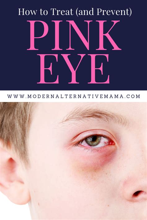 How To Treat And Prevent Pink Eye