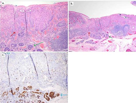 Cureus Squamous Cell And Adenoid Cystic Carcinoma Collision Tumor Of
