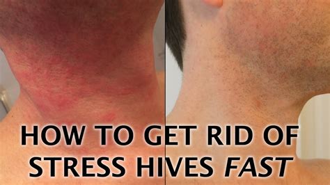 Stress Hives Causes Symptoms And Treatments Of A Stress Rash