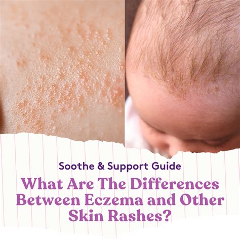 Eczema Vs Other Skin Rashes Whats The Difference Itchy Baby Co