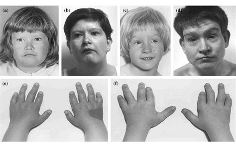 Figure 3 From Drayers Syndrome Of Mental Retardation Microcephaly