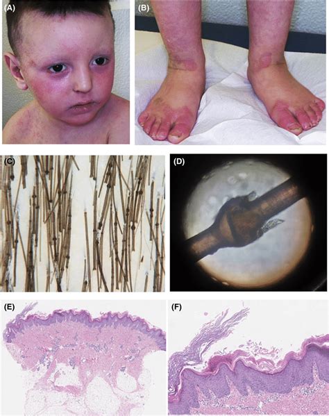 A B Erythematous Scaly Lesions And Erosions With Periferical Fine