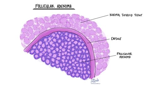 Follicular Adenoma In The Thyroid Gland Mypathologyreportca