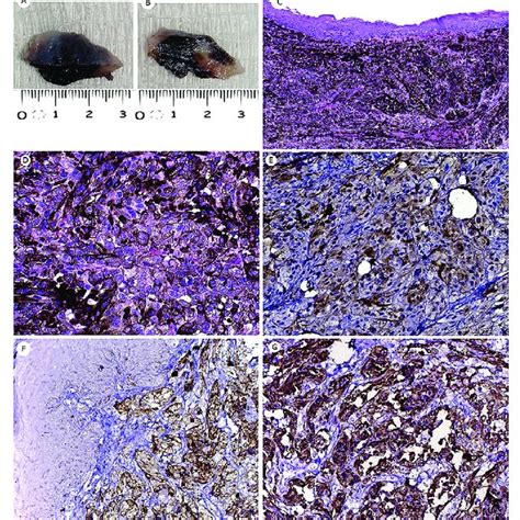 Gross Appearance Microscopic And Immunohistochemical Findings Of Oral