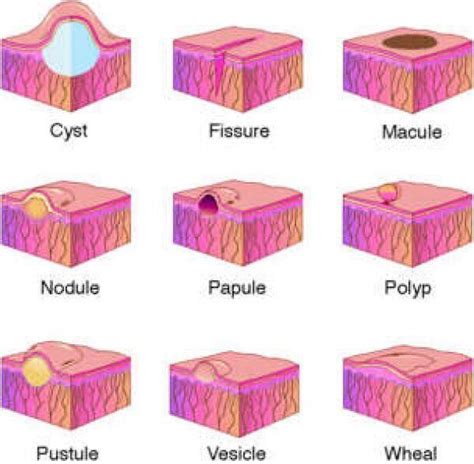 Skin Lesion Cyst Fissure Macule Nodule Papule Polyp Pustule