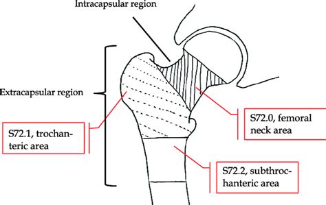 Classification Of Hip Fracture Type By Its Location Download