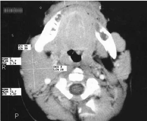 Axial Ct Image Of The Neck Shows An Ectopic Thymus In The Right