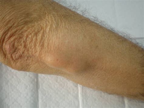 Rad Nodule On Elbow Rheumatoid Arthritis Psoriatic Arthritis