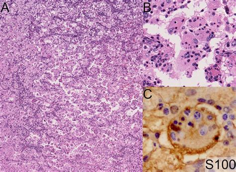 An Intriguing ‘cyst Of The Ear Journal Of Clinical Pathology
