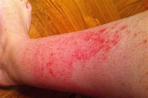 Ways To Get Rid Of Rash On Legs Howhunter
