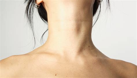 Hyperthyroidism Neck