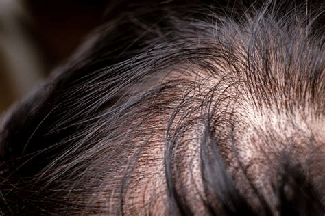 4 Ways To Hide Thinning Hair Circlecare