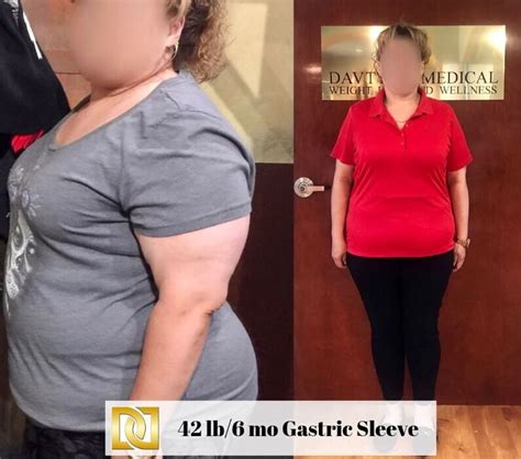 Balloon Weight Loss Surgery Before And After Bmi Formula