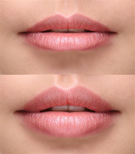 Lip Fillers Skintuition Medical Aesthetic Clinic