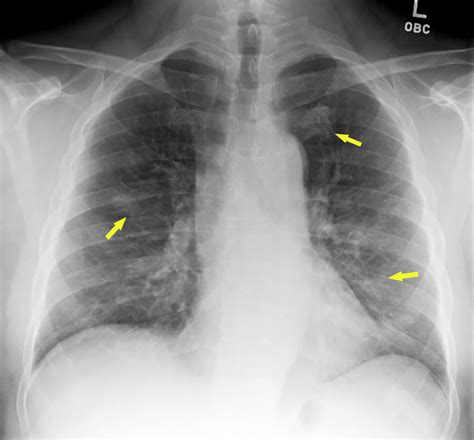 Cureus A Coronavirus Disease 2019 Covid 19 Patient With Multifocal