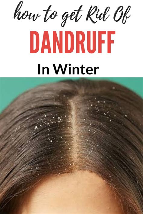 How To Get Rid Of Dandruff Naturally Permanently At Home Trabeauli
