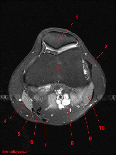 Plantaris can have variable size, but in most cases is difficult to demonstrate on routine mri studies. Atlas of Knee MRI Anatomy - W-Radiology
