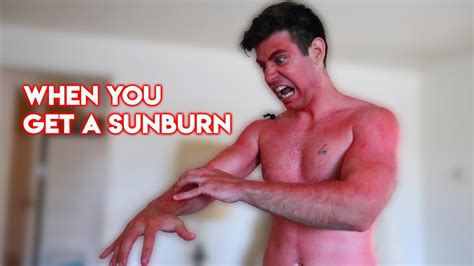 When You Get A Sunburn Youtube