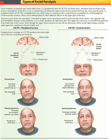 Types Of Facial Paralysis Peripheral Vs Central Lesions Facial Grepmed