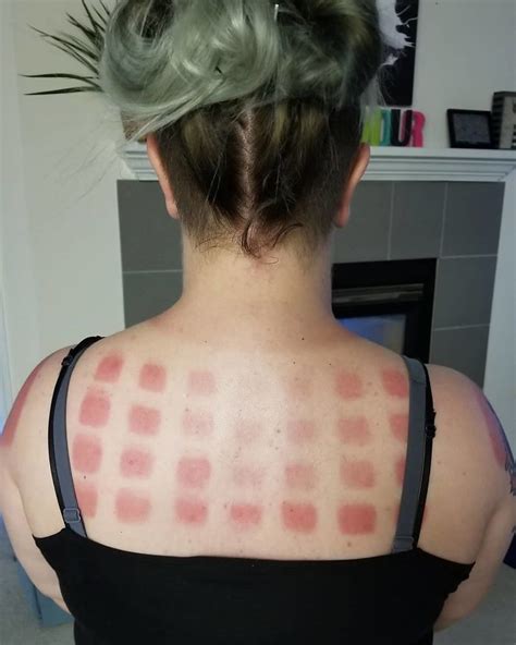 33 People Who Got Seriously Sunburned Ouch Gallery Ebaum S World