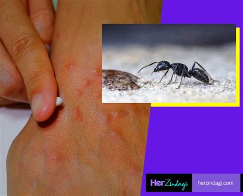 Home Remedies For Ant Bite Swelling Home Remedies For Ant Bite