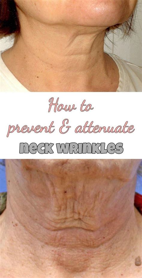 How To Prevent And Attenuate Neck Wrinkles Neck Wrinkles Tighten