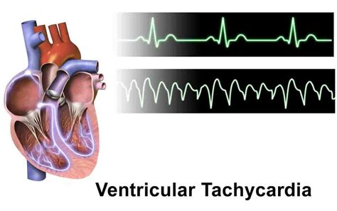 Ventricular Tachycardia Causes Symptoms And Treatment 2023
