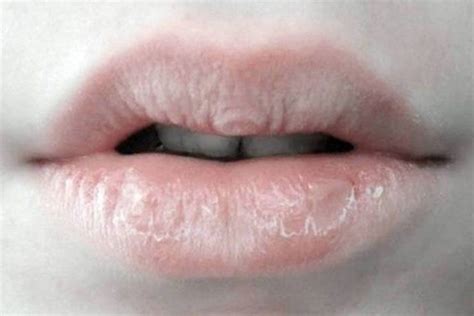 Natural Remedies To Avoid Having Chapped Lips Remedy You Lip