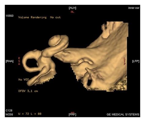Mri Scan With 3d Reconstruction Of Inner Ear Showing Cochlear Anomaly
