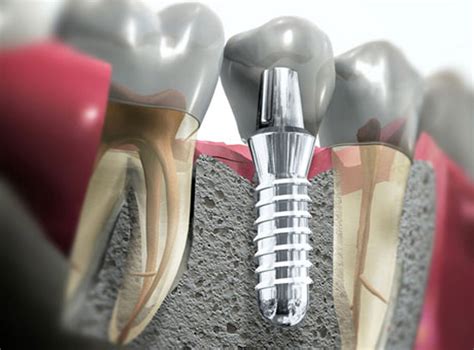 Имплантация зубов: противопоказания и возможные осложнения - Zubi32.com - л...