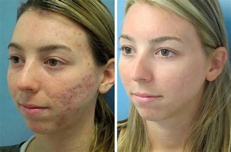 Acne Treatments Acne Specialists Same Day Appointments