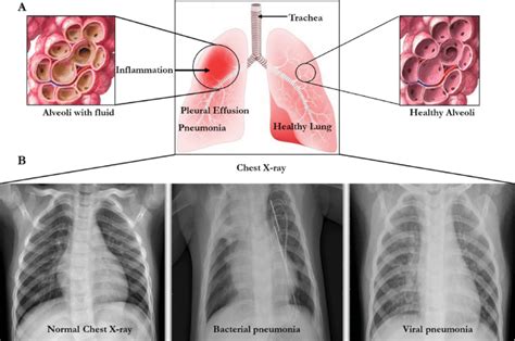 The Lungs And Chest X Rays Showing Inflammation Leading To Pneumonia Download Scientific