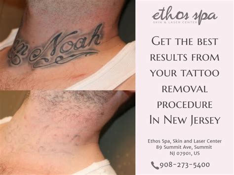 Maybe you would like to learn more about one of these? What is the Hardest Color Tattoo to Remove?