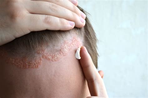 Seborrheic Dermatitis Hair And Scalp Solutions Mackay