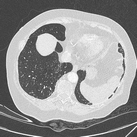 Chronic Exogenous Lipoid Pneumonia Image Radiopaedia Org