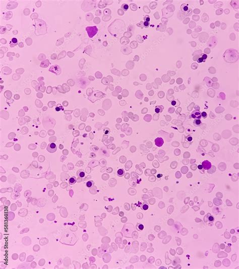 Plakat Hereditary Hemolytic Anemia Hemoglobin E Hbe Disease Smear