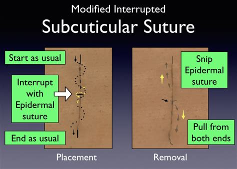 Subcuticular Suturing Pearls Closing The Gap