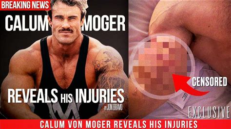Calum Von Moger Shows His Injuries Youtube