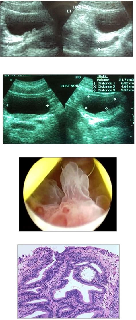 Figure 3 From Cystitis Cystica Mimicking As Bladder Tumour Semantic