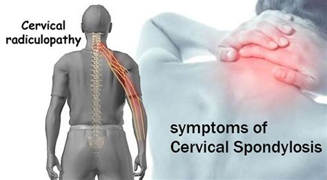 Cervical Spondylosis Adalah Tanda Penyebab Gejala Cara Mengobati My XXX Hot Girl