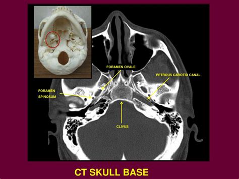 Ct Skull Base Anatomy