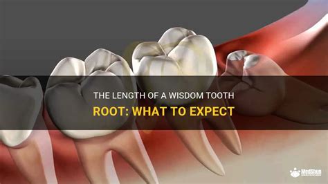 The Length Of A Wisdom Tooth Root What To Expect Medshun