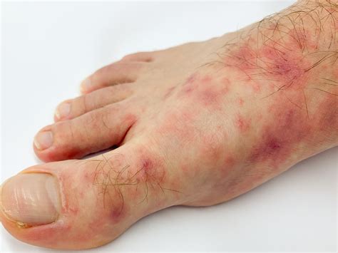 7 Types Of Foot Rashes How To Treat Them Causes Rash