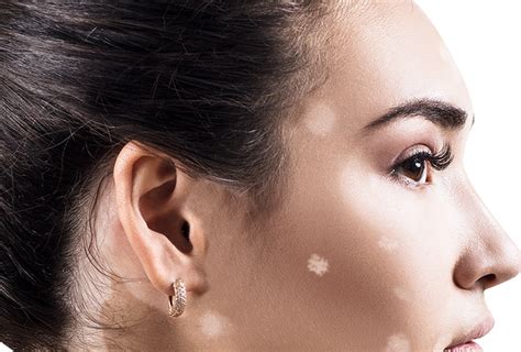 White Patches On Face Vitamin Deficiency