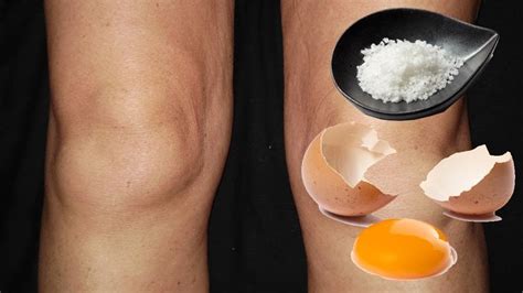 Natural 2 Ingredient Home Remedy For Treating Swollen Knees Swollen